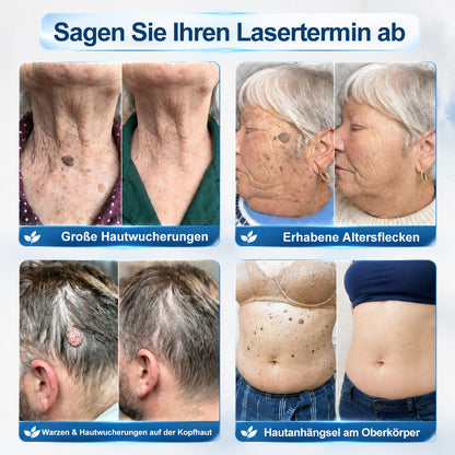Offizieller Markenstore |✅𝑷𝑖𝒄𝐝𝐨® 7-𝑻𝒂𝒈𝒆 𝑯𝒂𝒖𝒕𝒂𝒏𝒉ä𝒏𝒈𝒔𝒆𝒍- & 𝑭𝒍𝒆𝒄𝒌𝒆𝒏𝒆𝒏𝒕𝒇𝒆𝒓𝒏𝒆𝒓(Schmerzfreier Rollerball – Keine Narbenbildung)🚀