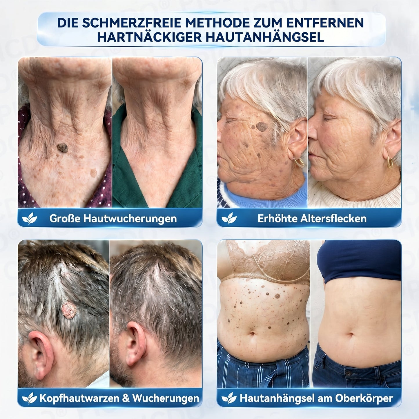 𝐏𝐢𝐜𝐝𝐨® 🍃 𝐂𝐑𝐄𝐌𝐄 𝐆𝐄𝐆𝐄𝐍 𝐇𝐀𝐔𝐓𝐀𝐍𝐇𝐀𝐍𝐆𝐒𝐄𝐋&𝐏𝐈𝐆𝐌𝐄𝐍𝐓𝐅𝐋𝐄𝐂𝐊𝐄𝐍(Formel ohne Schmerzen und Narben) 🎉