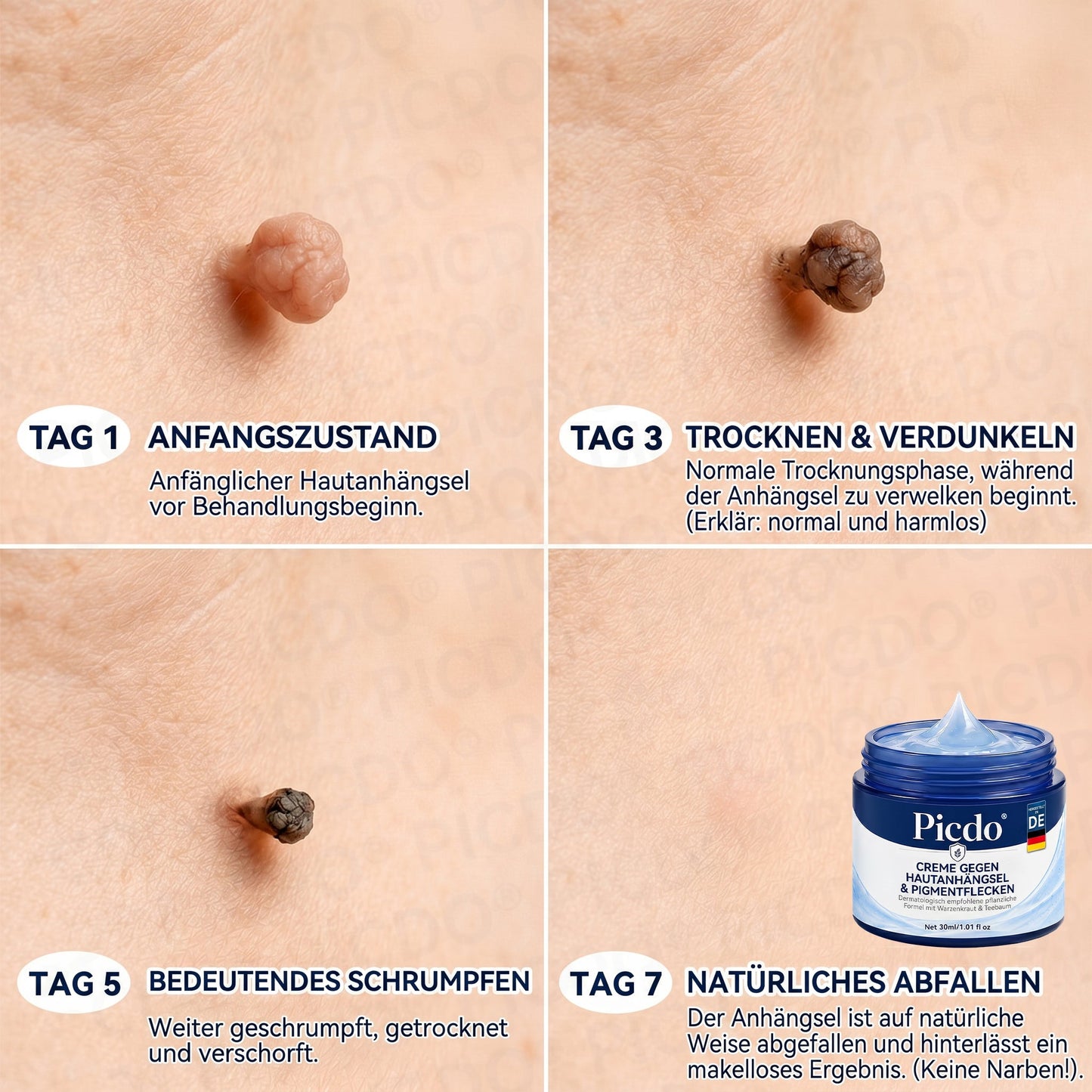 𝐏𝐢𝐜𝐝𝐨® 🍃 𝐂𝐑𝐄𝐌𝐄 𝐆𝐄𝐆𝐄𝐍 𝐇𝐀𝐔𝐓𝐀𝐍𝐇𝐀𝐍𝐆𝐒𝐄𝐋&𝐏𝐈𝐆𝐌𝐄𝐍𝐓𝐅𝐋𝐄𝐂𝐊𝐄𝐍(Formel ohne Schmerzen und Narben) 🎉